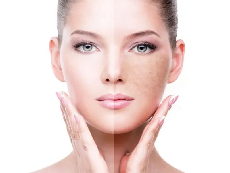 Face showing pigmentation on one side and clear skin on the other