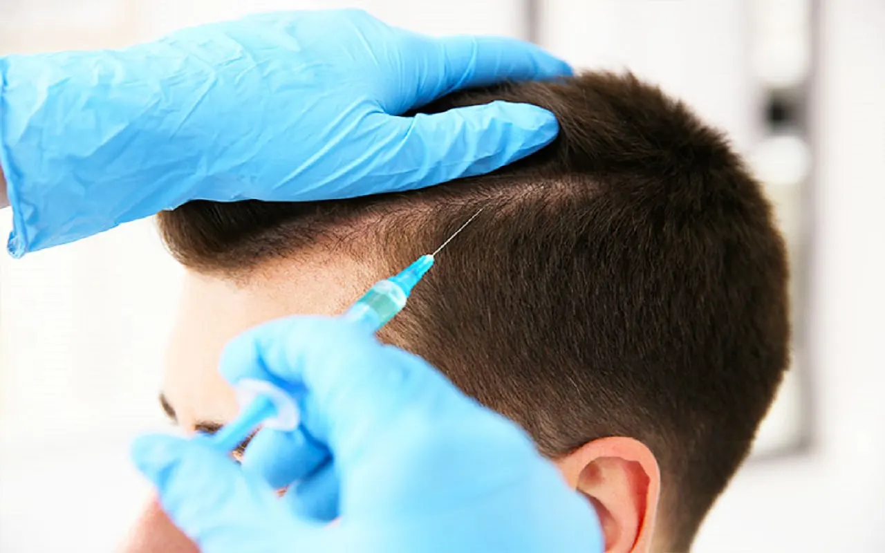 PRP injection being administered to the scalp