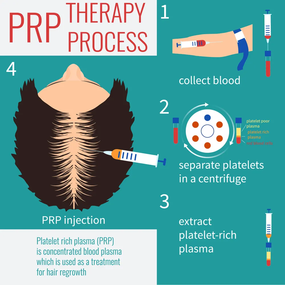 Infographic of the PRP therapy process for hair regrowth